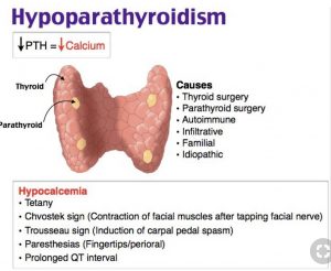 hypoparathyroidism symptoms
